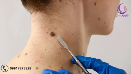 خال گوشتی و راه_های از بین بردن آن (1)